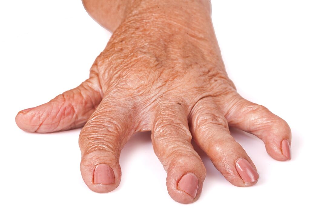 El medicamento HondroFrost contra el dolor articular. 