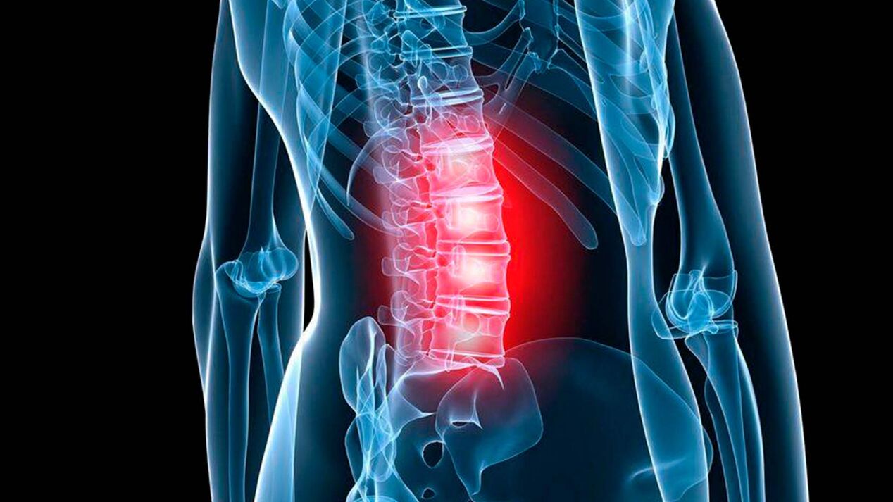 síntomas de osteocondrosis lumbar