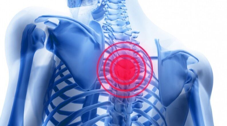 El dolor de espalda puede deberse a una hernia de disco