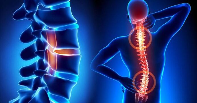 localización del dolor en la osteocondrosis