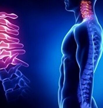La osteocondrosis cervical puede ser causada por lesiones en el cuello.